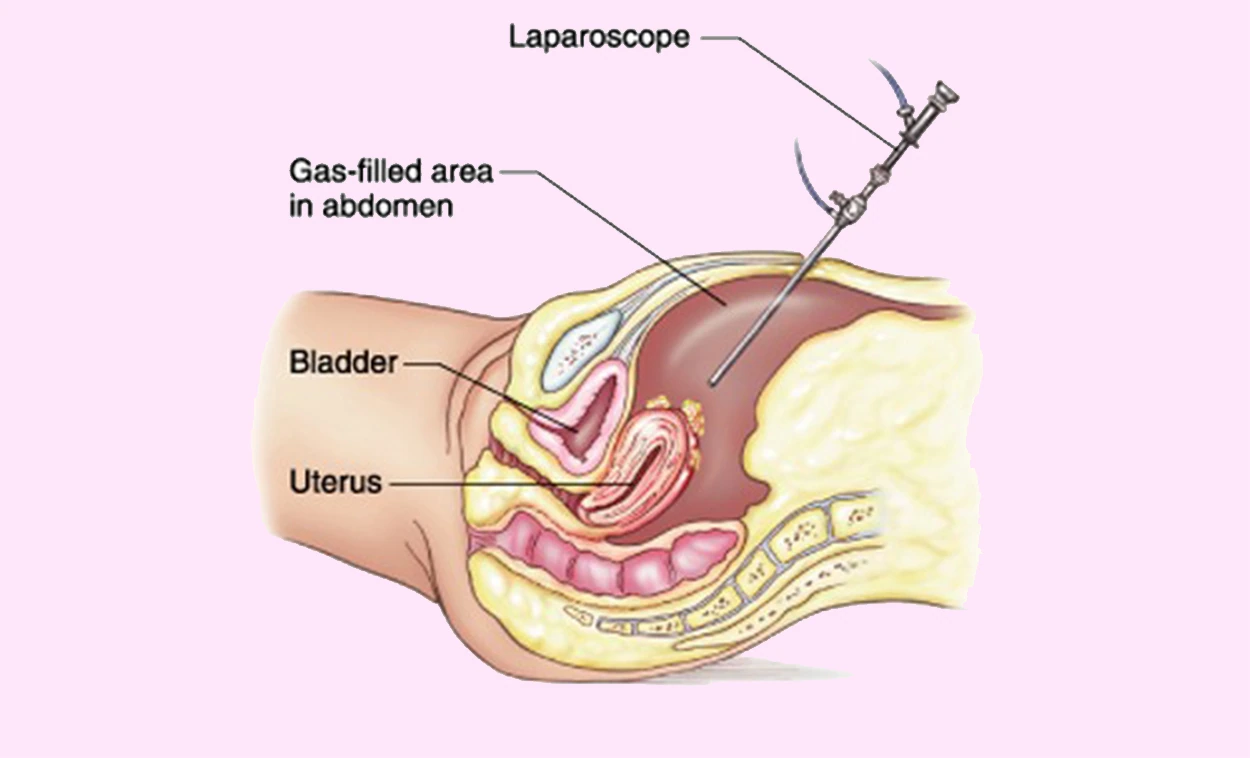 Laparoscopy